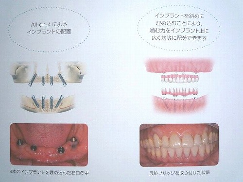 碧南市 歯医者 インプラント 歯周病 入れ歯